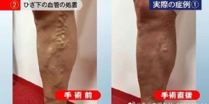 【千亿体育】东京血管外科定制super glue治疗方式，成功为张琳芃治愈静脉曲张